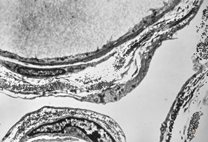 M,6y. | the wall of an arachnoid cyst